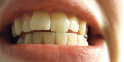 Ako si vybieliť zuby a získať žiarivý úsmev