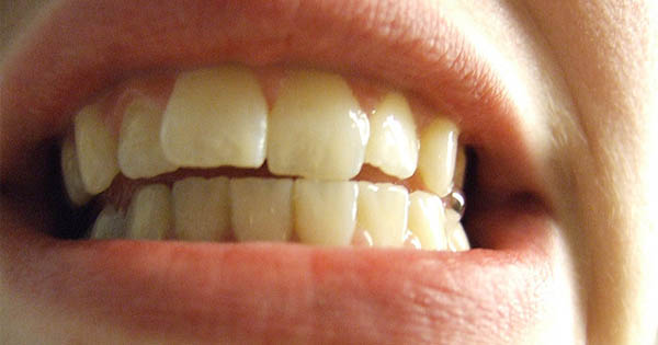 Ako si vybieliť zuby a získať žiarivý úsmev